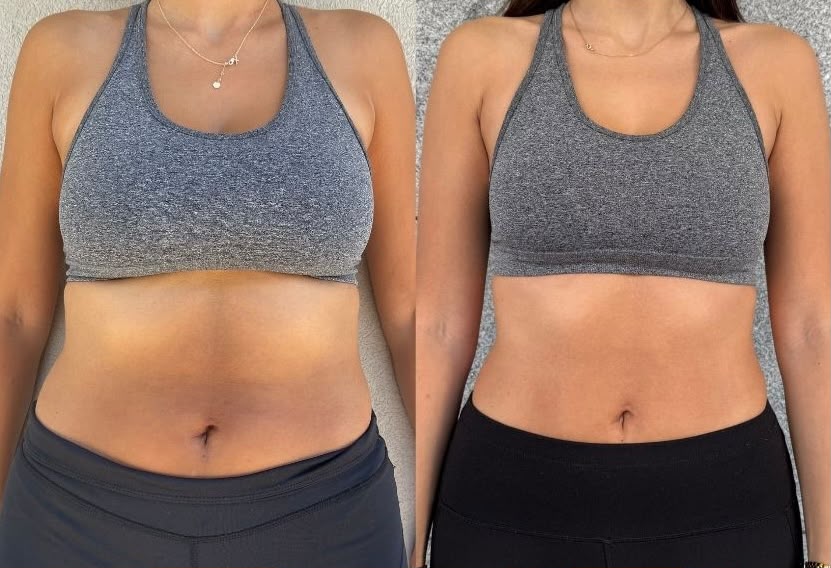 Antes e depois da Beatriz Pinto